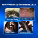 Kem bôi hỗ trợ giảm bong tróc da đầu gàu ngứa Stada 200 Cream 30g – CHO MỌI CẤP ĐỘ DA ĐẦU